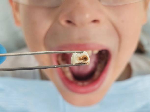 Best Emergency Root Canal Treatment in Awendaw, SC